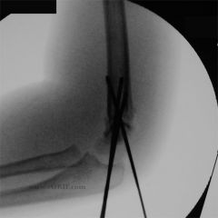 What is the advantage of medial and lateral crossed pins compared to two lateral pins in the treatment of supracondylar humerus fractures?