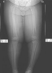 what xray measurements is abnormal and is therefor define Adolescent Bount's disease?
(aka)