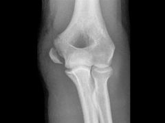 A 15-year-old high level Little League pitcher sustains an injury to his dominant elbow shown in Figure A. Radiographs demonstrate 7mm of displacement. Which of the following treatments will result in the highest rate of bony union?