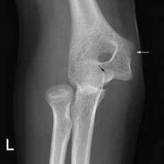 Medial epicondyle fractures are the most common fractures patterns associated with elbow dislocations in a child.  

Rasool reports in a Level 4 study that 33% of the children sustaining elbow dislocations had concomitant medial epicondyle fractures.