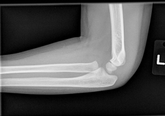 A 9-year-old boy fell off of a swing set and injured his left elbow. Radiographs are shown in Figures A and B. Open reduction and internal fixation of this fracture is indicated secondary to which of the following: