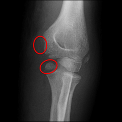 An 11-year-old child sustains an elbow dislocation. The elbow is reduced, but post-reduction radiographs demostrate that the ulnohumeral joint remains slightly incongruent. What is the most likely etiology for this continued incongruency? Topic