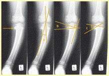 (b)-metaphyseal-diaphyseal angle (Drennan) ;
>16 degrees is considered abnormal
 angle between line connecting metaphyseal beaks and a line perpendicular to the longitudinal axis of the tibia