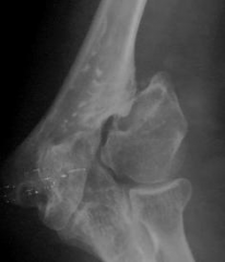 Nonunion following a pediatric lateral condyle fracture has been associated with which of the following?
