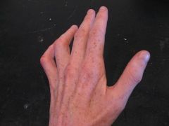 A 36-year-old male presents for left hand weakness. clnical photograph of his hand is shown. His medical history is significant for the elbow injury  Current radiographic evaluation of the patients elbow will most likely reveal what deformity?
