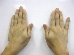 1 Ulnar claw consists of:hyper-extension of the MCP joints-index and ring fingers; 2  Froment sign (compensatory thump IPJ flexion 3 Wartneberg sign (persistent abduction and extension of the small digit during active adduction
