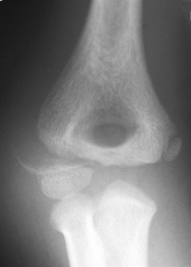Figure A shows the radiograph of a 6-year-old girl after a fall on the playground. What is the most appropriate course of action