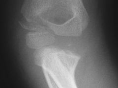 Figure A shows the radiograph of a 6-year-old girl after a fall on the playground. What is the most appropriate course of action?