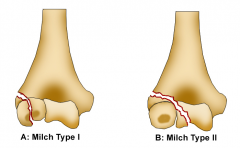 blood supply to  lateral condyle of the distal humerus comes posteriorly. Nonunions occur because of these fractures are intra-articular and bathed in synovial fluid, the characteristic deformity is a cubitus valgus & ulnar nerve sx.MT1-SH4; MT2-SH2