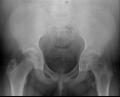 A 13-yo obese boy complains of a 3 mth hx of L knee, thigh & groin pain. His pain has sign worsened over the past wk. He denies pain in the R leg. Xrays Fig A&B. The hx & PE do not reveal any findings for an endocrine dis. tx?