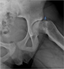 14yo fem presents with a hx of an un-dx L SCFE 3yo ago.  2 yrs of activity-related L hip pain & pain sitting. PE - restricted hip flex. motion, an ER deformity & obligatory ER upon hip flex manuevering. Xray Fig A&B. Which  osteotomies is MOST approp?