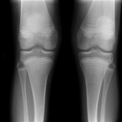 A 10-year-old girl has bilateral knee radiographs as shown in Figure A. Which of the following conditions is most likely present?