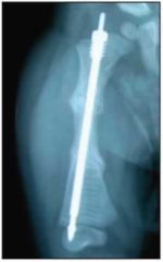 Osteogenesis imperfecta (OI);dense parallel bands in distal fem& prox tibial & fibular metaphyses. xrays ass long-term bisphosphonate use, MoA inc BMD ex. pamidronate, risedronate, alendronate, olpadronate, neridronate