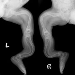 COL1A1/COL1A2 .  OI-->abnormal collagen type I. Clinical manifestions include multiple fractures, blue sclera, and scoliosis. The genes collagen synthesis are COL1A1/COL1A2.