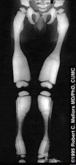 Which of the following radiographs is MOST consistent with osteopetrosis condition?