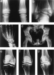 Which of the following radiographs is MOST consistent with MED or SED condition? multiple epiphyseal dysplasia/spondyloepiphyseal dysplasia