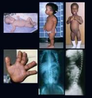 which of the following radiographs is MOST consistent with  achondroplasia condition?