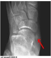 Surgical excision. no periosteal changes, bony destruction, or matrix present xray not 3 & 4 w/u of malignancy. Conservative measures 1st line treatment sx accessory navicular. Surgical for refractory TX