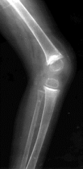 Scurvy
1 defition of condition; 2 genetic defct; 3 zone affect
4 xray findings; 5 sx-assoc PE-I/P; provc; n/v E 6 Tx