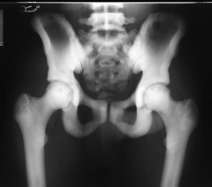 22yo male sustained a dis radius fx 2^ fall down the stairs. ER Doc noticed abn bone on the x-ray & referred skeletal survey & eval. Pelvis & spine xrays FigA & B. What etiology bony dz?