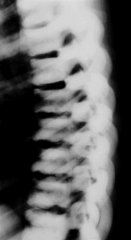 Defective osteoclast function; dense bone, loss of trabeculations, and narrow femoral canals. spine xray demonstrates the classic "rugger jersey" spine with very dense vertebral bodies.