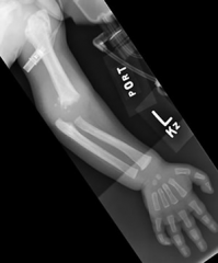 7-mo girl cries when the mother touches her swollen elbow. Xray Fig A. What is the most appropriate Tx? 1 ORIF 2. CRPP 3. CR & casting 4. Functional bracing 5.CR & hinged ex-fix