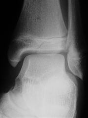 Fig A & B- AP/lateral XRAYS 15yo boy who injured his ankle skateboarding. What is the MoI with this type of fx? 1 sup/add; 2 Ex rotatn; 3 In rotatin; 4 pron/abd; 5 axial load