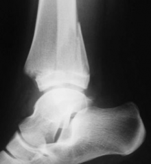 2 external rotation injury
triplane fracture that occurs in patients during early adolescence