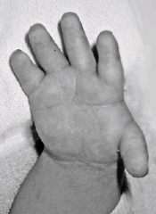 Fig A is a photograph of a newborn's hand. Genetic testing reveals-mutation in the SLC26A2 gene on Chrom 5q & both the parents were carriers. What condition does this child have?