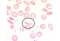 3 Sickle cell anemia; Salmonella osteomyelitis is assocd w/ SCA. MC cause osteomyelitis SCA is ->Staph A. MC spread of Salmonella from the GI tract. dactylitis (acute hand / foot swelling)  SCA 2 abn hemoglobin S alleles;