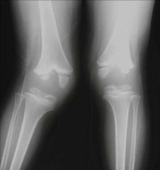 Hematogenous osteomyelitis caused by Salmonella is MC in which of the following pt popltn? 1 Neonates 2 IV drug abusers; 3 Patients with sca dz; 4 Pts w/ chronic kidney failr req HD 5 pts w/ puncture wounds through athletic shoe