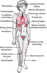 Sx care for pain w/ NWB crutches, IV hydration, & conslt w/ peds. SCA crises bone infarcts difficult diff from acute osteo. Radionuclide bone marrw & bone scan DDX osteomyelitis vs bone infarct.  sickle cell trait usu asymptc
