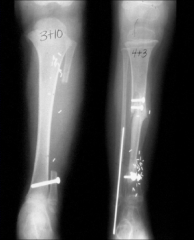 intramedullary nailing with bone grafting
free fibular graft
Illizarov's external fixation