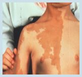 All of the following are assd w/ neurofibromatosis except:1 Smooth bordered café-au-lait spots; 2PM bowg tibia 3 Short, sharp dystrophic scoliosis; 4 Cutaneous neuromas; 5. AD transmission from mutated neurofibromin gene