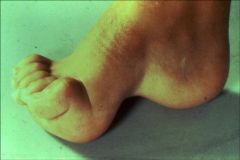 32 yo M c/o lat ft pain & progr awkward gait. (+) fam hx "foot problems" & reports minor burng & numbness b/l ft. PE b/l cavus feet-clawg toes & intrinsic muscle wastg hands. Fig A. Which is respon for pts initial sx & awkward gait?