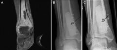 9yo B Tx'd for acut hematgns osteo dis tibia w/ IV ABX. After 3 days Tx, fails improv. MRI  1.5x1.5cm abscess-> dis tibia. pt undergoes I & D w/out complcts. F/u , which studies most expeditious methd  determine early success  tx?
