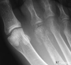 6 yo B tendrnss @ R heel & avoids puttg wt  R LE after steppg nail 2 wks wearg tennis shoes. fever-39.0. Calcaneal osteo caused puncture wound  incr'd rate of which comprd hematogns osteo?