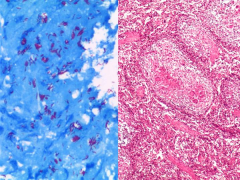 1 Multicentric giant cell tumor; 2 Letterer-Siwe dz; 3 Polyostotic mycobacterial infn; 4 Hand-Schuller-Christian dz; 5 Metastatic rhabdomyosarcoma; sx night sweats, bx multiple giant cells w/ caseous necrs.
