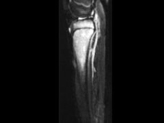 8 yo B, R leg while playg soccer 6 Ds ago. Initial xray neg, pt into  KI. Despite NWB pain worsn, bone scan MRI Fig B & C. PE no knee effsn but tendr prox tib. WBC & ESR nl, CRP is up. initial step mangmnt?