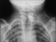 Sprengel's deformity failure shoulder descend caudally durg fetal devel, leads elevation & medial rotation inferior border scapula. assw/ Klippel-Feil syndrm, congnl scoli, fused ribs, omovertebral Bn & myelomeningocele.Ans2