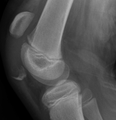10 yo G in ED c/o ant knee pn after  fall from bicke. PE-> ecchyms & swellg patella & extensr lag. lat xray Fig A. Next step Tx? 1 ORIF; 2. Quad tendn repair; 3 Cylndr cast 4 Knee asprtn; 5 Reconstrc patella tendon