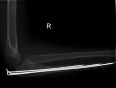 monteggia fx, always surgery. bc its unstable fractures - unable to reduce radial head and maintain ulnar length in this both bone forearm fx.