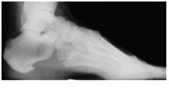 22yo F concerned about freq ankle sprns & awkward gait. LE nerve conduction velocities-> prolonged distal latencies in peroneal nerves. DNA testing shows a duplication of chrom 17. Which of the follwg is most likely xray of this pt?