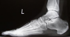 (CMT), is a demyelinating disorder of the peripheral nervous system. pes cavovarus, claw toes, and frequent ankle sprains. imbalance distal musculature, w/peroneus brevis and tibialis anterior being relatively overpowered by the peroneus longus