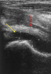 neoonatal septc arthritis-MC Grp B Strep; neonates nosocomial septc arthritis-MC Staph A >Group B Strp 2^ invasive procedures- central lines & indwelling catheters. 0-2 yrs highest freq septic arthritis. 6mth- 5 yrs, staph.Ans1