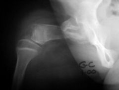 ACL is most likely defcnt pts w/ which follwg abns? 1-Cleidocranial dysplasia; 2-Congenital radial head; dislocation; 3-Apert syndrome; 4-Achondroplasia
5-Prox focal fem deficiency