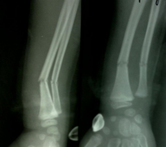 8yo B fell ridg bike & landad on outstretched arm. xrays Fig A. Which inc risk of displacement follwg CR & castg? 1-LAC; 2-SAC; 3-Cast index > 0.85; 4. Conscious sedation during reduction; 5. Plaster cast immobilization