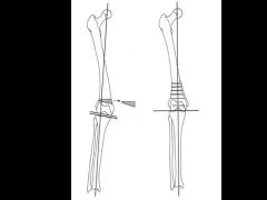 Which is the most appropriate S Tx?1-Lat closg wedge prox fem osteotomy w/ med openg wedge tib osteotmy; 2-Lat closg wedge tib osteotmy; 3-Med openg wedge fem osteotmy; 4-Med closg wedge tib osteotmy; 5-Med closg wedge fem osteotmyAns5