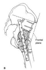 4-15°ER, 0° add, 20° flex 5-15° ER, 15° abd, 5°  flex::Hip arthrodesis-salvage procd for pts w/ hip DJD w/out ipsl knee, contralat hip,  lumbr spine path. optimal position= 0-5 add, 0-5 ER & 20-35 flex.  Add ,5 ER 5 flex2x(sum of 10)=20Ans2