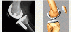3-Pos knee dislctn; 4-O-lysis; 5-Patellar instblty:: If knee is too loose-flex, possbl fem compnt "jump the post" grt pos dislctn. Tx-revision surgery only way to correct sx flex instability.Ans3